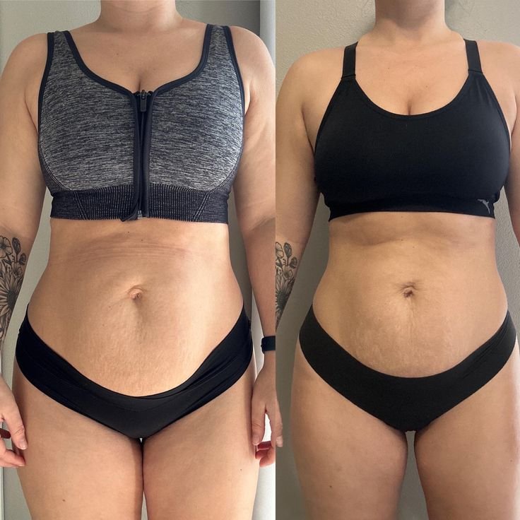 6-Week-Diastasis-Recti-Progress.jpg